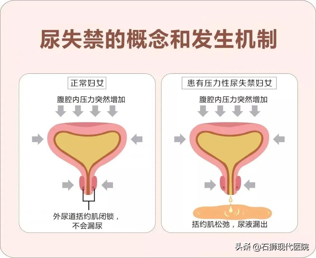 一笑就“湿身”?10几年痛苦一次解决