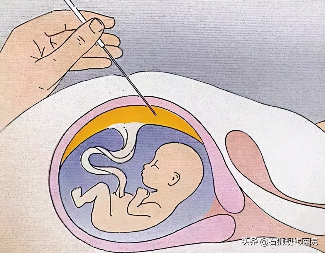 「傻傻分不清」唐筛or无创DNA检测or羊水穿刺,你选择对了吗?