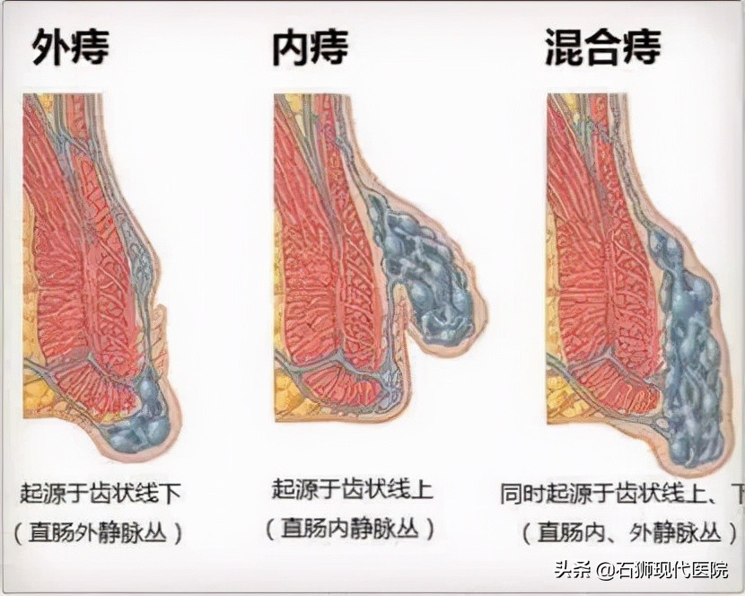 得了痔疮到这里来,安全又疗效好!石狮人早知道就少遭罪