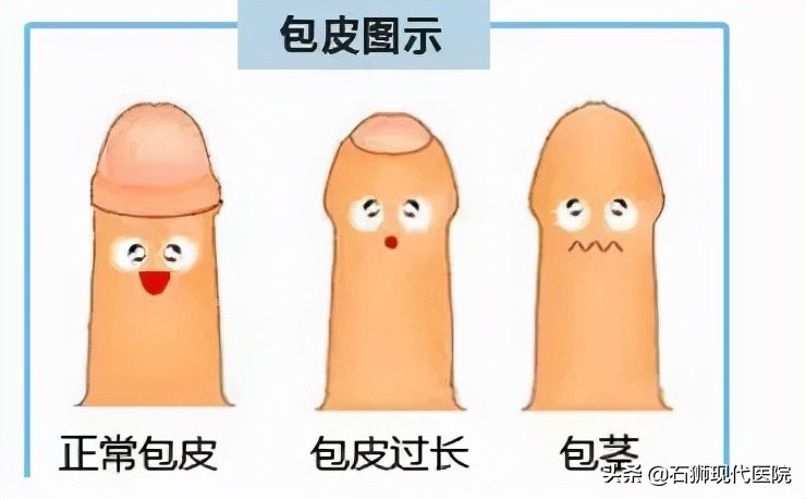 家长们看过来!孩子包皮长不长?割不割?看完你就懂了