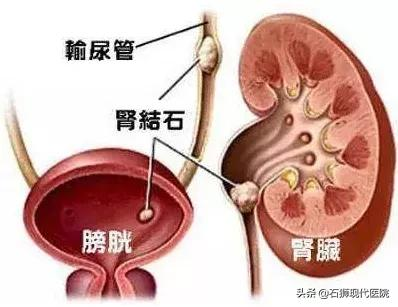 腰痛难耐?血尿不止?有这些情况马上到医院就诊,肾会感激你