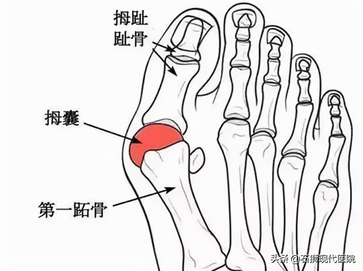 它,也喜欢高跟鞋美女——拇外翻