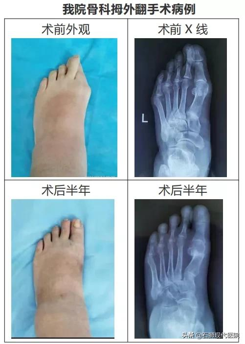 它,也喜欢高跟鞋美女——拇外翻