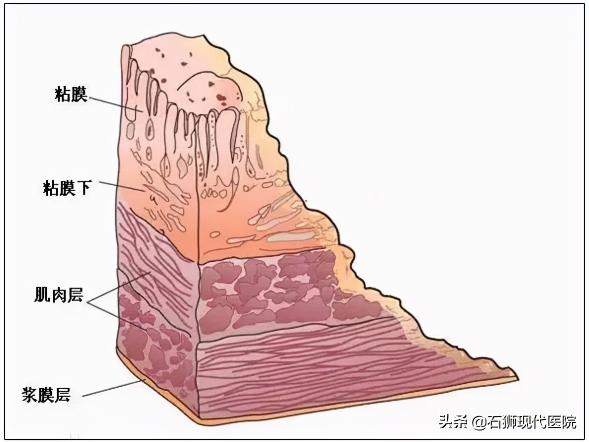为什么胃癌筛查首选胃镜?