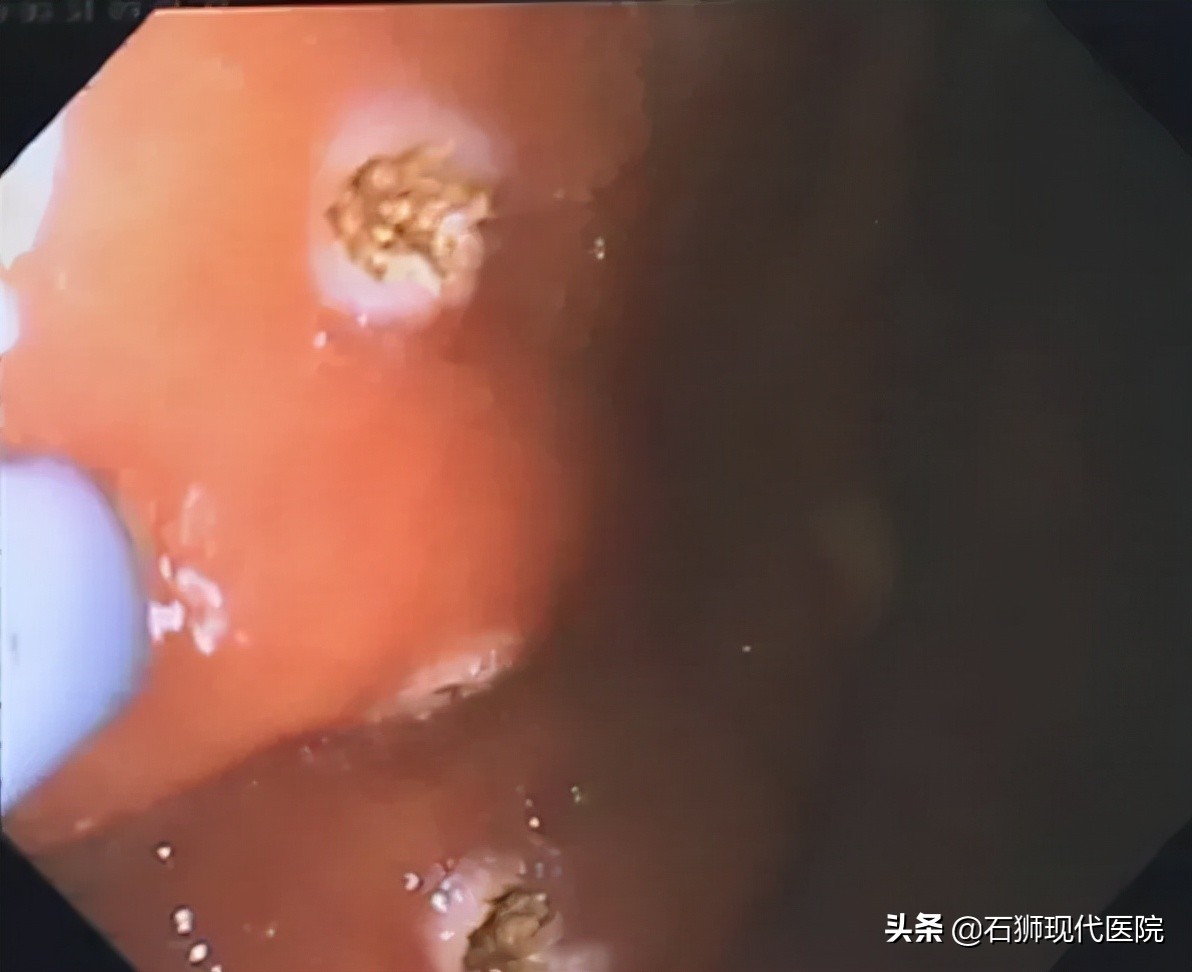 为什么胃癌筛查首选胃镜?
