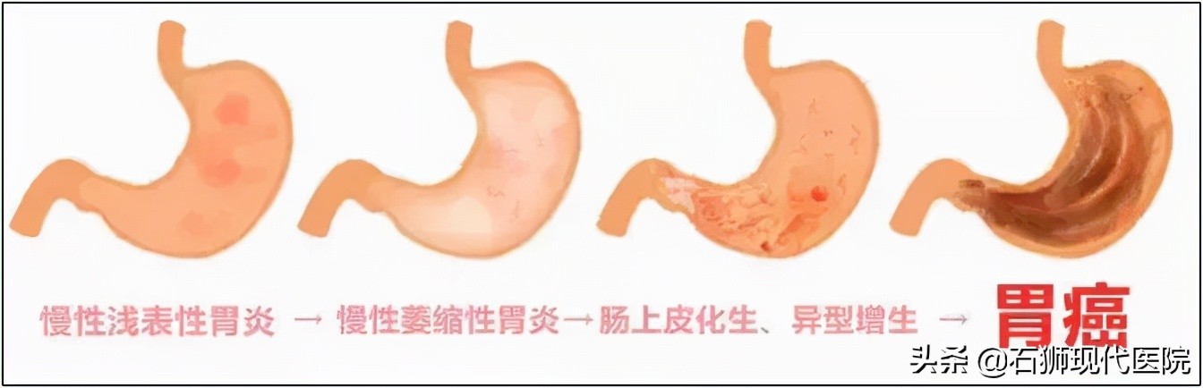为什么胃癌筛查首选胃镜?