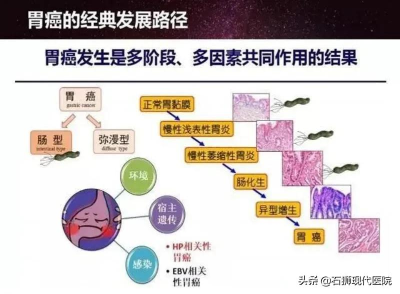 为什么胃癌筛查首选胃镜?