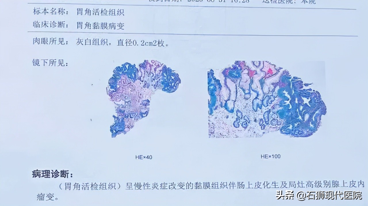 胃镜发现这种“黄色瘤”要警惕早胃癌的可能性