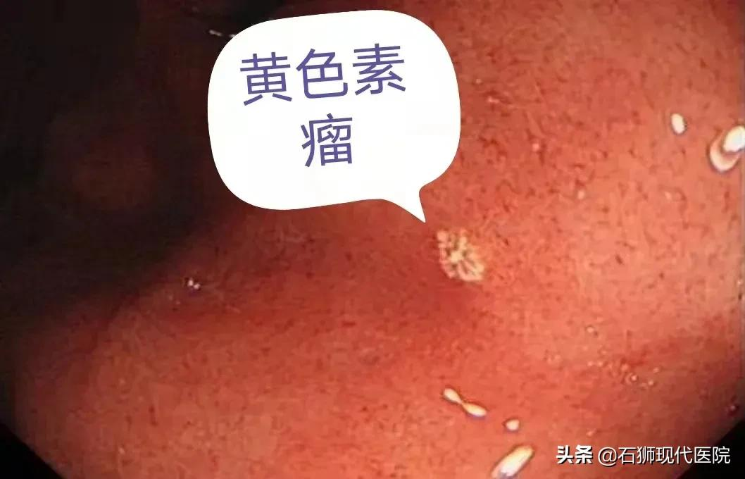 胃镜发现这种“黄色瘤”要警惕早胃癌的可能性