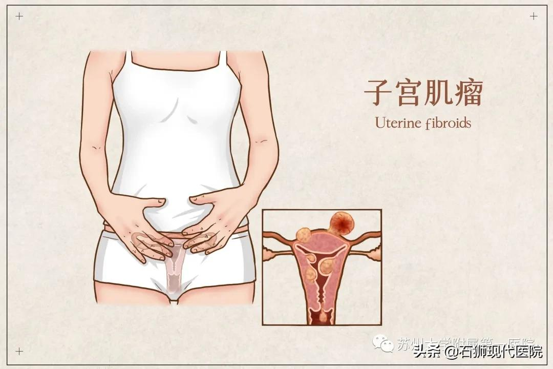 发现子宫肌瘤,孕妈妈该怎么办?