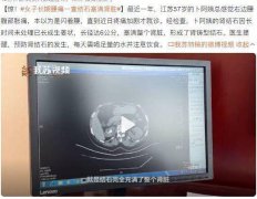 小心！你的结石可能是“吃”出来的！