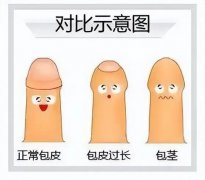 割包茎手术一般多少钱？
