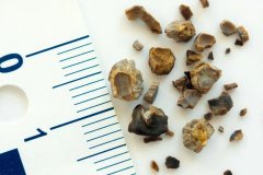 夏季泌尿系统结石高发，这些人尤其注