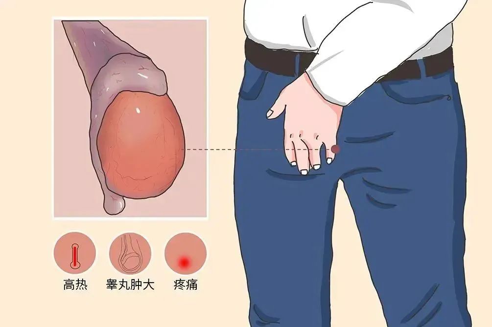 睾丸炎.jpg 图片