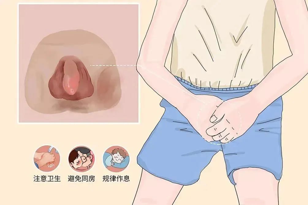 包皮炎和龟头炎.jpg 图片