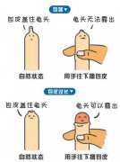 包皮要不要割?怎么割，在哪里割最放心