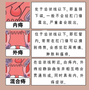 内痔看似不痛不痒，实际危害大到超出