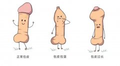男人为什么要割包皮？选择割包皮的几