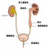 泌尿系结石有个“疼痛等级榜”，长在