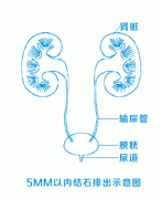 小便时排出了肾结石，是否意味着痊愈