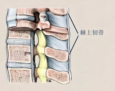 反复腰痛两月，中医辨证治疗两次痊愈