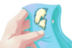 白带呈豆腐渣样？当心是这类妇科病