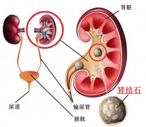 没痛的肾结石真的不用管吗？医生：很