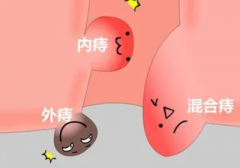 【石狮哪家医院治疗痔疮较好】外痔能