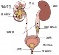 小心泌尿系结石：“小石头”成大隐患