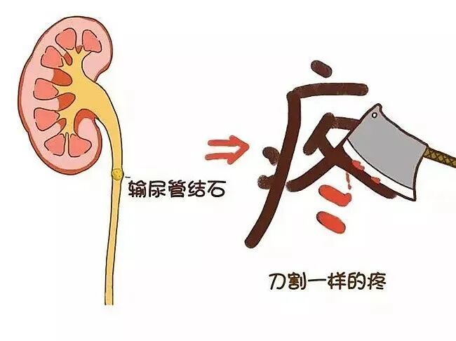 输尿管结石多喝水就好了？这2个不可逆危害，你肯定不知道_治疗