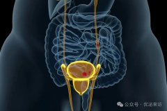 得了泌尿系结石，生活中应注意什么？