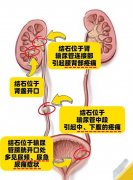 泌尿结石如何治疗？石狮现代医院科学