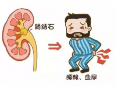 结石也是“秋老虎”，秋季结石预防也