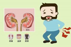 【肾结石】，别让“小石头”变成大麻