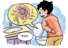 腰突然疼到直不起？小心是肾结石在“