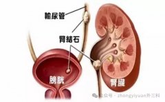 肾结石对肾有损伤吗