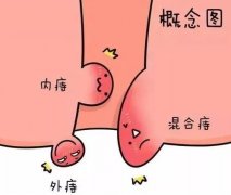有痔疮别硬扛！拖延不仅难自愈，当心