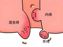痔疮vs肛裂vs肠癌：如何区分这些“难言