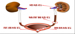 “沉默的肾脏杀手”：肾结石防治指南