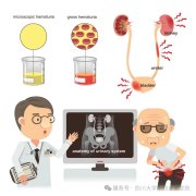 输尿管结石：小石头，大麻烦！【石狮