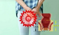 混合痔需要手术吗?【石狮肛肠科医院哪
