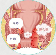 痔疮分几种？内痔、外痔、混合痔有什