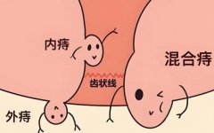 作为痔疮患者，我还患有其他疾病，会