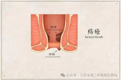 【石狮肛肠医院】痔疮久拖不治有哪些