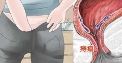 痔疮能自愈吗？【石狮肛肠医院】