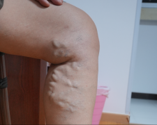 【石狮治疗静脉曲张的医院】忍了十几