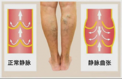 为什么静脉曲张总是治不好？【石狮专