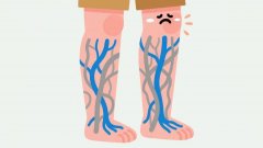 【石狮治静脉曲张哪家医院好】不只是