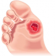 【石狮糖尿病足哪个医院治疗好？】烫