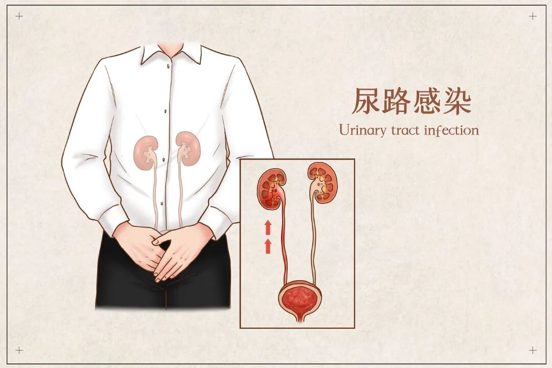 摄图网_401793635_尿路感染医疗插画(非企业商用).jpg